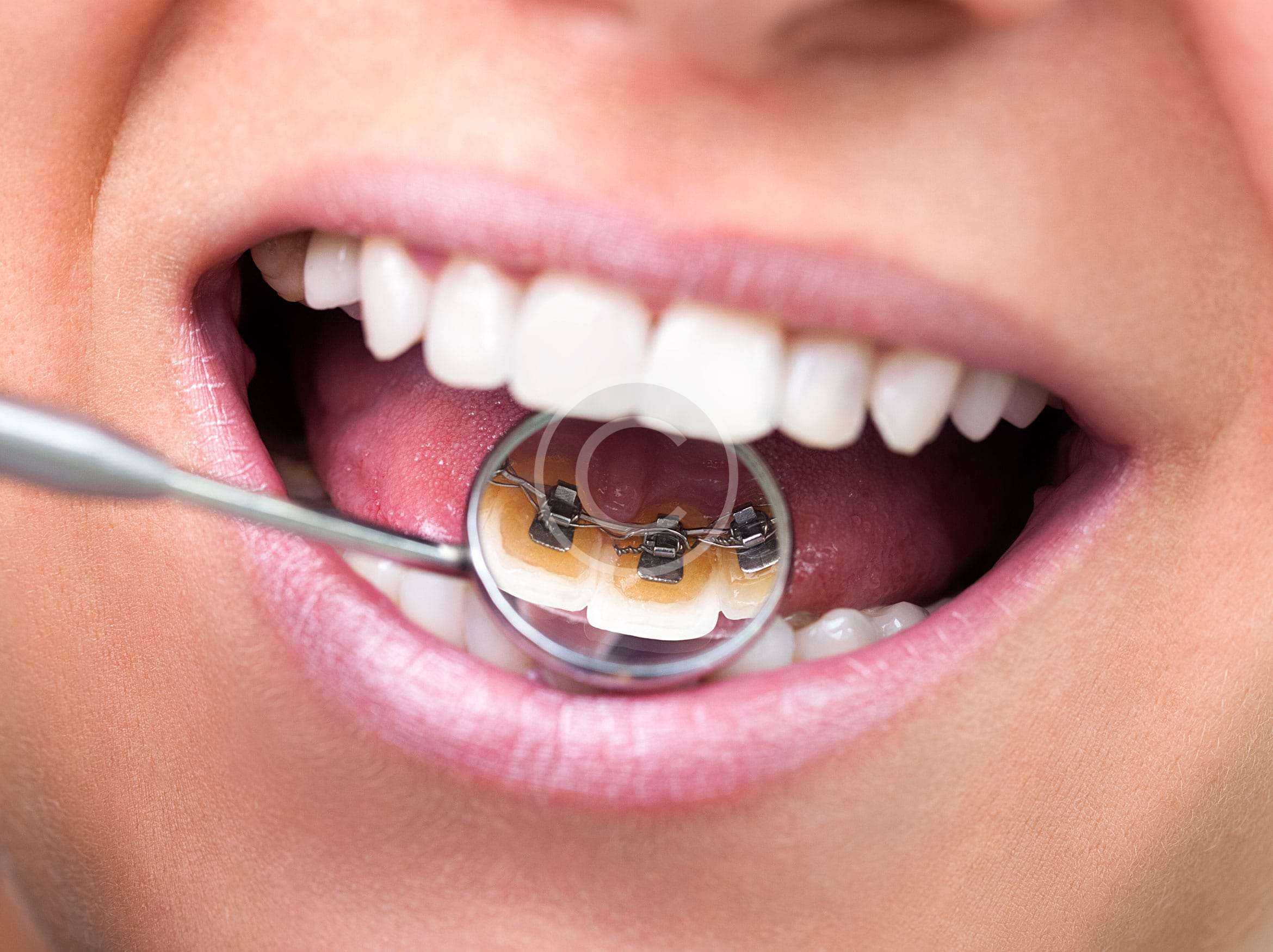 Quality Braces
