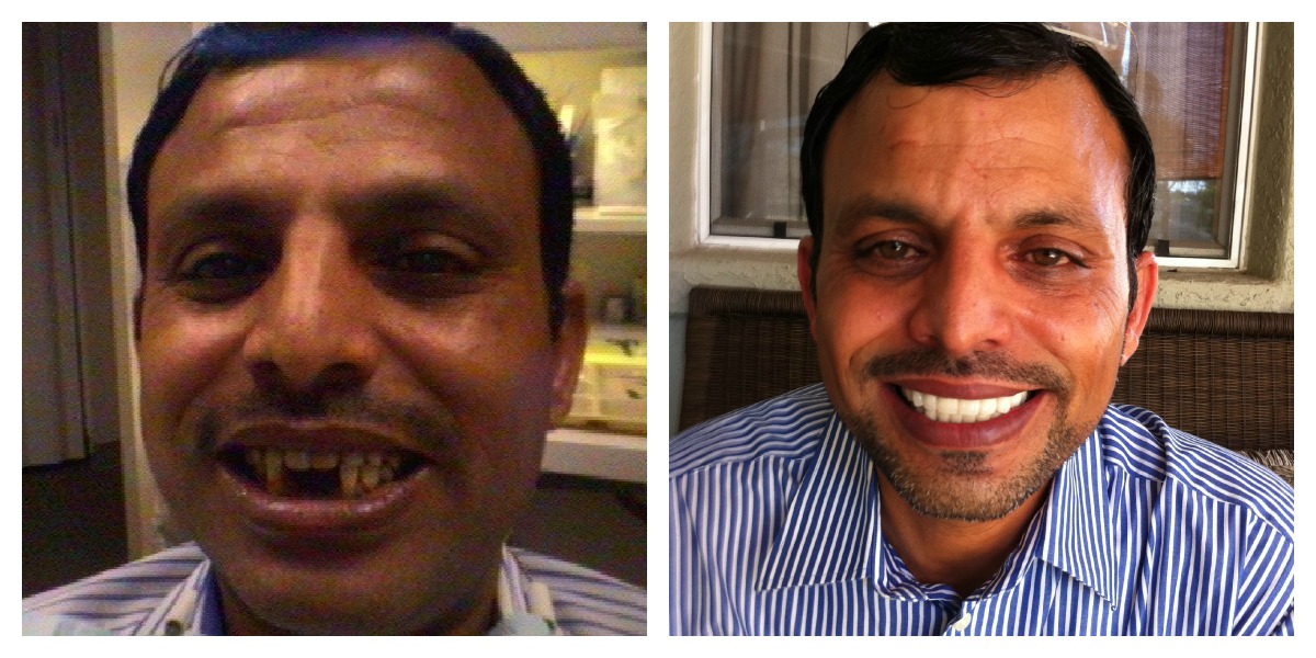 Before and after smile transformation