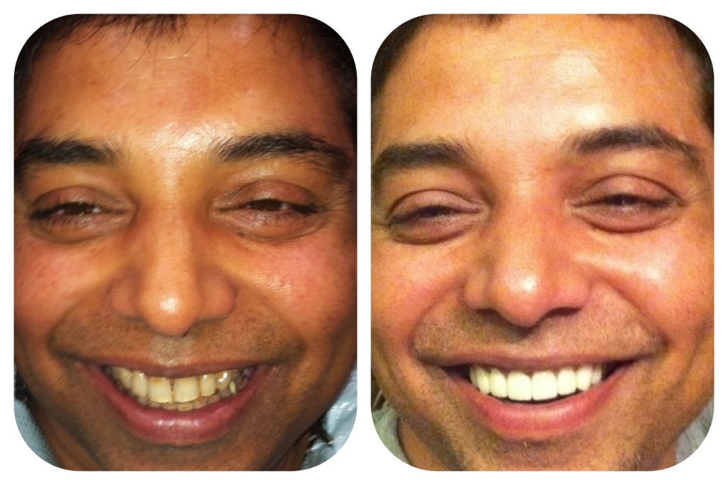 Before and after natural-looking smile result