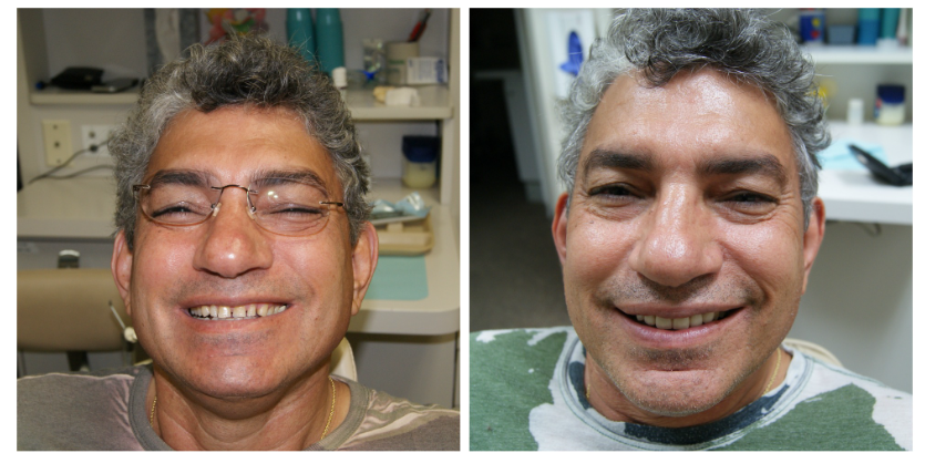 Before and after naturally restored smile