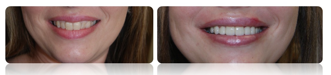 Before and after smile transformation at Parsons Family Dental